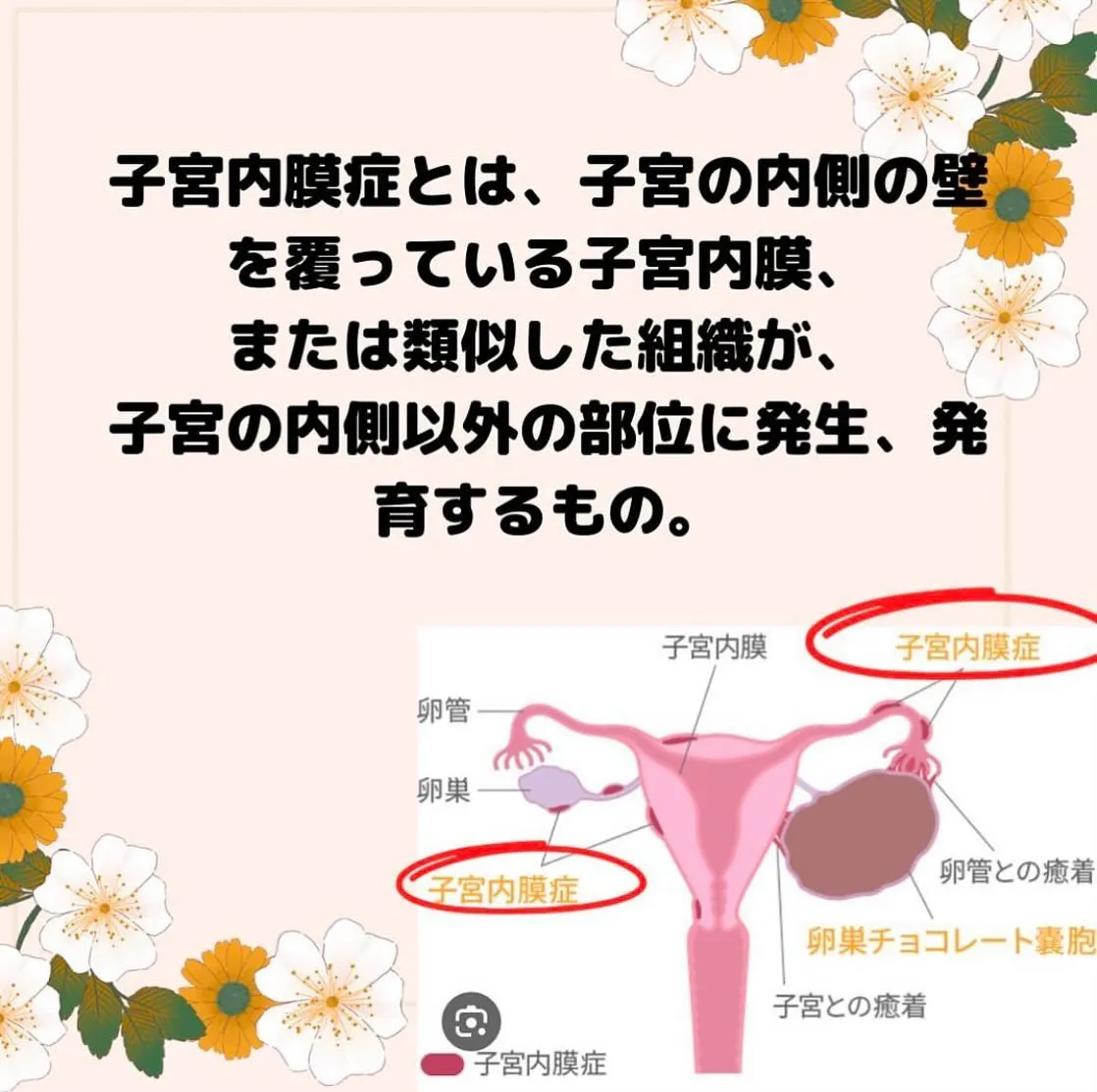 【子宮内膜症って？　としみ】