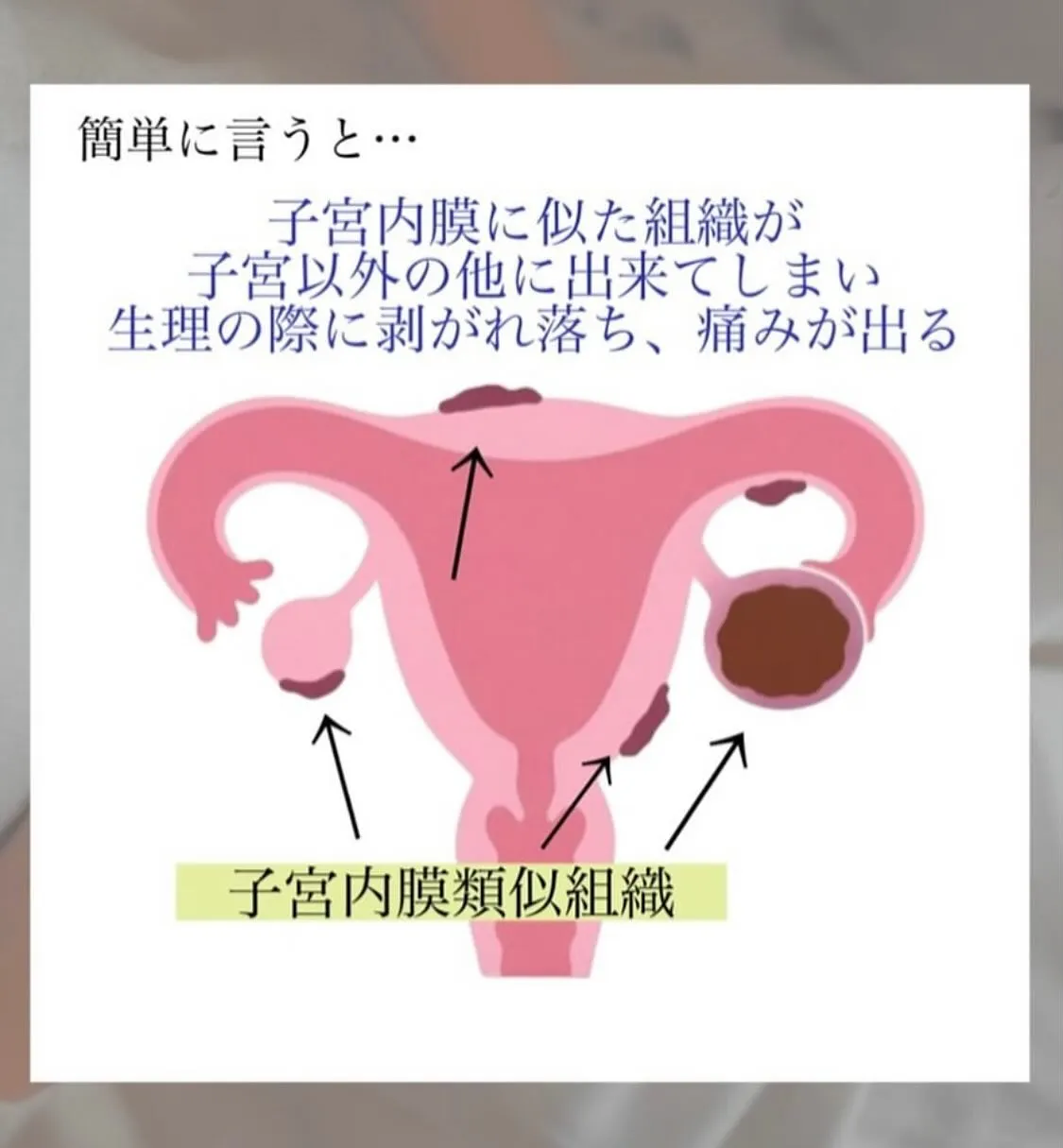 【子宮内膜症とは？　ひろみ】