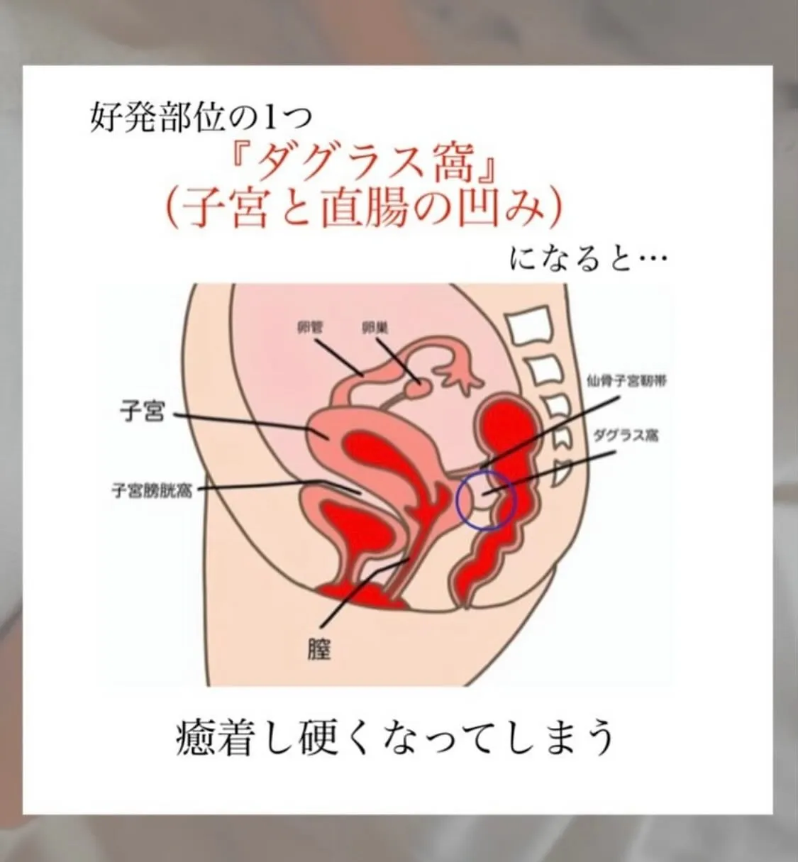 【子宮内膜症とは？　ひろみ】